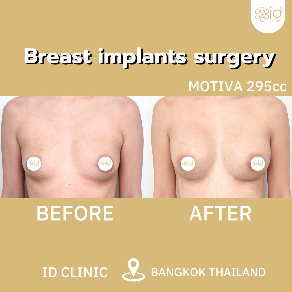 Breast Implant Surgery